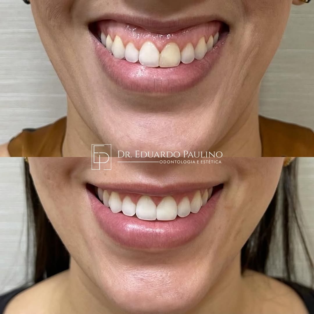 Correção de Sorriso Gengival — antes e depois
